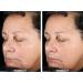 Buy Miracle Wrinkle Filler - 90 Second Results with Hyaluronic Acid for Youthful Skin | Fast International Shipping - Buy Online on GoSupps.com