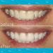 Smileactives Prolite LED Teeth Whitening Kit + Whitener Pen with Gel - Achieve White Teeth - Buy Online on GoSupps.com
