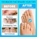 GWAZI Gel Toe Separators - 2 Pairs (Blue) for Women - Bunion Corrector, Toe Straighteners, Toe Spacers, Toe Spreaders - Toe Alignment and Pain Relief (4 pcs) - Buy Online on GoSupps.com