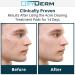 Acne Clearing Treatment Pads - Salicylic, Glycolic & Lactic Acid Formula for Cystic Breakouts and Oily Skin - Buy Online on GoSupps.com