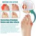 Bunion Cushions - Self-Adhesive Bunion Pads for Bunion Relief and Foot Protection | 1PC - Buy Online on GoSupps.com