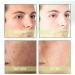 Anti Acne Face Serum Herbal Acne Repair Serum Face Smoothing Pore Acne Skincare Serum Acne & Scar Natural Tea Extract for Sensitive Skin Skin Repair & Fade Acne Mark Hydraulic Acid Serum for Face-30ml - Buy Online on GoSupps.com