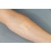 Clozex Emergency Laceration Kit - FDA Cleared Skin Closure Device for Wound Repair - 8 Piece Set - Buy Online on GoSupps.com