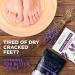 Lavender Oil Foot Soak with Epsom Salt for Dry Cracked Feet - Made in USA - 1 LB Lavender - Softens Calluses, Soothes Sore Feet & Removes Odor - Athlete's Foot Relief - Buy Online on GoSupps.com