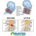Trusted Cervical Neck Traction Device - One Size Fits All - US Owned - Relief for Chronic Neck & Shoulder Pain - Inflatable Neck Stretcher Collar - Buy Online on GoSupps.com