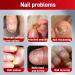 Fungal Nail Treatment Cream Antifungal Nail Polish Cream Nail Fungus Treatment for Toenail Strong Anti-Fungal Toenail Cream Nail Improve Cream Nail Repair Cream for Thick Cracked Discolored Nails - Buy Online on GoSupps.com