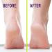 Heel-Seal Liquid Skin Protectant for Cracked Heels - Foot Repair & Care Treatment | Callus, Blister, and Cracked Feet Relief | 0.17oz 1-Pack with Applicator and Buffer - Buy Online on GoSupps.com