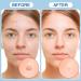 Invisible Pimple Patches - 110 Ultra Thin Hydrocolloid Acne Dots for Daytime Use - Effective Whitehead Treatment - Buy Online on GoSupps.com