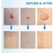 OakRidge Products Skin Tag Remover Painless Pen Removal Kit Tools with 40 Micro and Regular Bands Easy Device to Remove(1mm-8mm) Tags (2in1 Kit) (2-8mm) Blue Number Of Items: 1 1.0 count - Buy Online on GoSupps.com