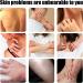 Antifungal Cream:Jock Itch Cream Soothing Eczema Relief Cream All-Natural Soothing Care & Fast Relief of Jock Itch Eczema Psoriasis - Ringworm Treatment for Humans - for Adults and Kids - Buy Online on GoSupps.com