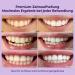 ONLYSMILE Professional Tooth Bleaching Set | All-in-One Instant Teeth Whitening Kit | Safe Painless Tooth Whitening for Bright White Smiles - Buy Online on GoSupps.com