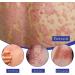 BLEDD Psoriasis Repair Spray - Professional Plaque Psoriasis Treatment for Skin (3pcs) - Buy Online on GoSupps.com