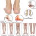 Adjustable Supination Insoles for Flat Feet & Plantar Fasciitis | Arch Support Orthotic Inserts for O/X Type Legs - International Shipping - Buy Online on GoSupps.com