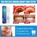 Teeth Whitening Abbey Set - 4 Piece Tooth Whitening Pen Kit for Quick & Gentle Stain Removal - Effective Bleaching Essence Safe & Tooth-Friendly - Buy Online on GoSupps.com