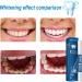 Teeth Whitening Pen - Effective Bleaching Gel for White Teeth (2PCs) | Remove Stains & Brighten Smile - Buy Online on GoSupps.com