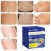 Silicone Scar Sheets 6 Pack for C-Section, Surgery, Burn, Post-Acne & Stretch Marks - 4x150cm - Buy Online on GoSupps.com