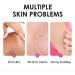 Extra Strong Yellow Peeling Oil Yellow Peeling Oil Extra Strong Peeling Oil for Dark Skin Extra Strong Peeling Oil Extra Strength Exfoliating Peeling Solution for Body Dead Skin Remover (3PC) - Buy Online on GoSupps.com