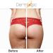 Anti-Acne Thigh & Buttocks Treatment - Clear Pimples & Ingrown Hairs, Prevent Breakouts - 6.09 oz - Buy Online on GoSupps.com