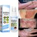 Dubush 30ml Herbal Psoriasis Relief Spray - Natural Eczema & Psoriasis Treatment - Soothing Moisturizing Mist - Set of 3 - Buy Online on GoSupps.com