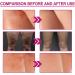 Butt Acne Treatment Butt Pimple Clearing Treatment Cream Butt Acne Treatment Balance Oil Butt Pimple Removing Cream Butt Acne Cream Reduce Acne and Pimple 100ml Butt Acne Treatment - Buy Online on GoSupps.com