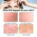 20% Azelaic Acid Serum Cream Azelaic Acid Cream Face Serum Skin Care Beauty with Niacinamide & Vitamin C Reduces Blackheads Acne Rosacea - Buy Online on GoSupps.com