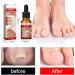 Ingrown Toenail Treatment Nail Growth Ingrowing Toenail Treatment Nail Helper Fungal Nail Treatment Correction Oil Drops Ingrown Toenail Corrector Toe Nail Fungus Treatment Cuticle Oil - Buy Online on GoSupps.com