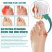 Bunion Relief Fit Patch - Strongjoints Anti Bunion Corrector for Pain Relief - Toe Spacers for Foot Pain (3 Box/18pcs) - Buy Online on GoSupps.com