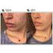 BioClarity 3-Step Acne Routine Mini Size | Clean Vegan Acne Treatment for Oily Skin | Includes Cleanser & Gel Set - Buy Online on GoSupps.com