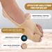 Orthopedic Bunion Corrector - Pain Relief for Women & Men | Soft Gel Pads & Spacer | Big Toe Straightener - Beige - Buy Online on GoSupps.com