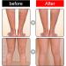 XIYINLI 12pcs Varicose Veins Patches | Skin-Friendly & Non-Toxic Relief for Swelling & Pain - Buy Online on GoSupps.com