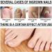 Ingrown Toenail Treatment Oil - Natural Drop for Cuticle Care & Fungal Nail Correction - 10ml (1Pcs) - Buy Online on GoSupps.com