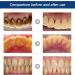 Effective Tartar & Yellowed Teeth Mouth Spray - Long-Lasting Freshness | International Shipping - Buy Online on GoSupps.com