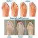 Orthopedic Women's Bunion Correction Sandals - Arch Support, Open Toe, Flat Sole - Buy Online on GoSupps.com