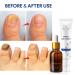 Fungal Nail Treatment Kit - Stop Fungus & Restore Healthy Toenails - Buy Online on GoSupps.com
