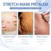 Stretch Strip Repair Cream for Women - Advanced Stretch Mark Removal | Professional Post-Birth Skin Care - Buy Online on GoSupps.com