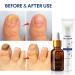 Natural Heals Nail Fungus Treatment Kit - Liquid & Cream for Healthy Toenails | Repair Fungal Infections, Stop Fungus Growth, Extra Strength Formula - Buy Online on GoSupps.com