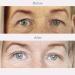 Doirollr 400pcs 3MM Single-Sided Eyelid Tapes Stickers Medical-use Fiber Eyelid Strips Instant Lift Eye Lid Without Surgery Perfect for Hooded Droopy Uneven Mono-eyelids Size 3mm transparent One-sided sticky Red - Buy Online on GoSupps.com