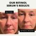 Retinol Serum for Face - 2.5% Pure Anti-Wrinkle Serum with Hyaluronic Acid & Vitamin B3 | Resurfacing Anti-Aging Treatment for Men & Women - Facial Acne Solution - Buy Online on GoSupps.com