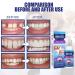 Buy Temporary Tooth Repair Kit | Dental Adhesive Set & Formable False Teeth for Quick Fixes - Buy Online on GoSupps.com