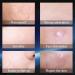 252 PCs Sugelary Pimple Patch 2-in-1 Invisible Hydrocolloid Pimple Patches | Effective Anti-Acne Solution (8mm & 12mm) - Fast International Shipping - Buy Online on GoSupps.com
