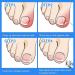 30 Pieces Ingrown Toenails Feet Ingrown Nail Set Ingrown Nail Lifter Ingrown Toenail Corrector Ingrown Toenail Toenails for Foot Thicknesses (Transparent) - Buy Online on GoSupps.com