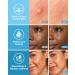 LitBear Acne Pimple Patches Blue & Yellow Star Shaped Acne Cover Patch Hydrocolloid Acne Patches For Face Zit Patch Acne Dots Add Tea Tree Oil 112 Patches 14mm & 10mm Sky Blue & Yellow Star - Buy Online on GoSupps.com