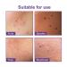 144Pcs Acne Stickers for Home, Irregular Shape Pimple Elimination - Acne Patches - Buy Online on GoSupps.com