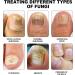 SenhE Fungus Laser Therapy Device Antibacterial Laser Equipment Light Therapy Device Fungal Nail Revolutionary High-Efficiency Light Therapy Device for Toenail Diseases  - Buy Online on GoSupps.com
