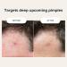 Cardon Prickly Pimple Patches - Salicylic Acid Spot Treatment for Acne Blackheads & Blemishes (9 CT) - Instant Zit Clearing & Razor Bump Relief - Buy Online on GoSupps.com