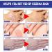 Chirsfairy Psoriasis Relief Treatment Spray 30ml - Soothes Itching, Gentle Skin Hand Foot Relief - 3PCS - Buy Online on GoSupps.com