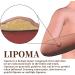 LumpFree Lipoma Cr me d maquillante instantan e au lipome cr me d maquillante aux lipomes aux herbes cr me v g tale naturelle pour liminer les grumeaux de lipome 20 g - Buy Online on GoSupps.com