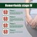 SouthMoon Hemorrhoids Cream Fast Acting Relief from External Itching and Burning Natural Hemorrhoids Treatment Cream (1PC) - Buy Online on GoSupps.com