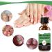 Nail Fungus Treatment For Toenail - Extra Strong Fungal Nail Treatment - Anti fungus Nail Repair and Strengthen Fix & Renew Damaged Broken Nails (2PC) - Buy Online on GoSupps.com