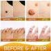 Samsali Skin Tag Remover Pads - 42 Count | Advanced & Effective Skin Tag Removal - Buy Online on GoSupps.com